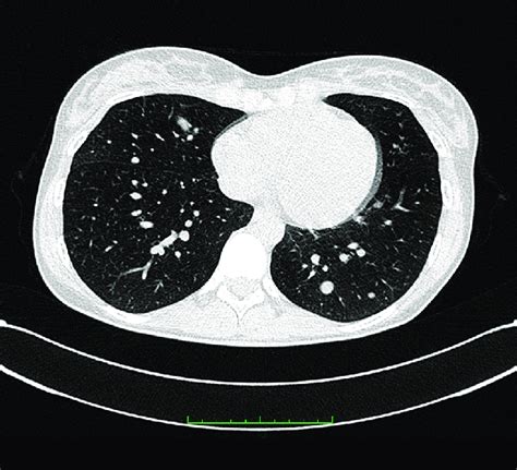 CT scan of pulmonary metastases -05.2012 (Horos, v 3.3.5). | Download ...