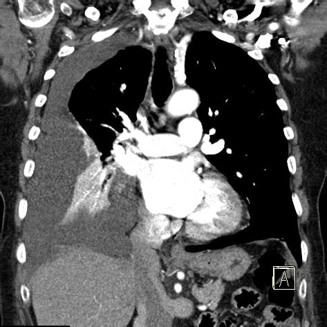 Computertomographie Ct Radiologie Saalekreis