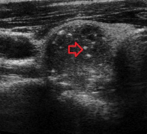 Albums 103 Pictures Pictures Of Thyroid Nodules On An Ultrasound Superb