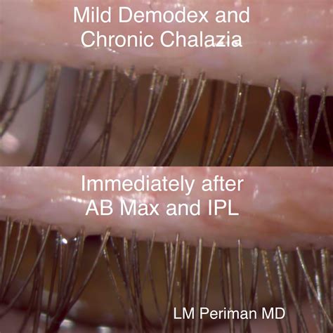 Demodex Dry Eye Master