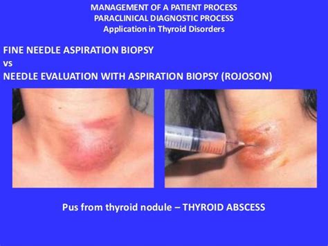 Application Of The Management Process In Thyroid Nodules