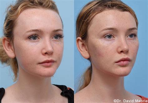 Before After Photos Of Non Surgical Facial Rejuvenation Contouring With