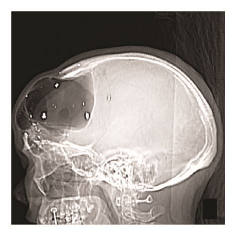 Readmission CT head and maxillofacial-sinus scan. (a) Scout image... | Download Scientific Diagram