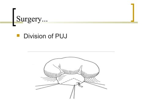 Puj Obstruction Ppt