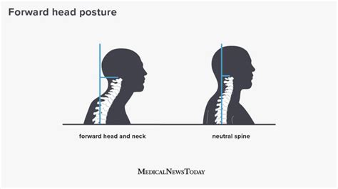 Forward Head Posture Definition Cause And How To Treat It Forward Head Posture Postures