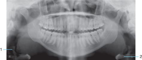 Panoramic Radiograph Landmarks Flashcards Quizlet