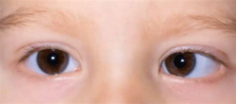 Strabismus Causes Symptoms Diagnosis Strabismus Treatment And Surgery