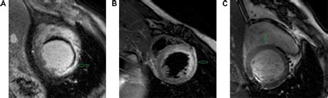 Frontiers Recent Advances In Fibrosis And Scar Segmentation From