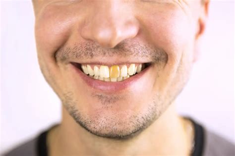 Izbjeljivanje Odumrlog Zuba Dentus Perfectus Ordinacija