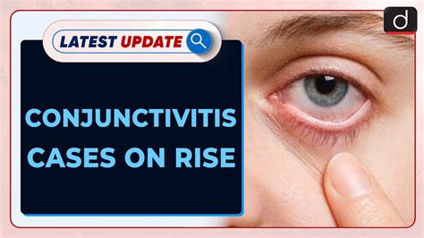 Conjunctivitis Cases On Rise Latest Update Drishti Ias English