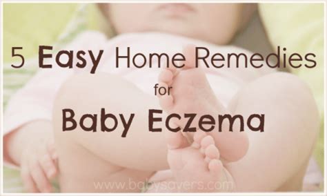 Baby Eczema Home Remedies