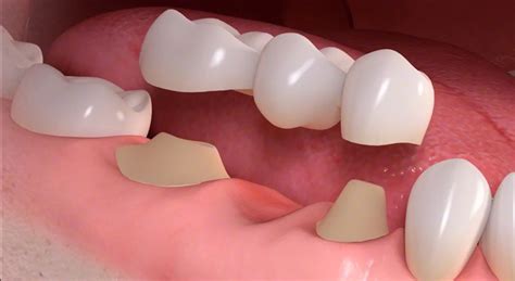 Pros And Cons The Differences Between Dental Bridges Vs Implants