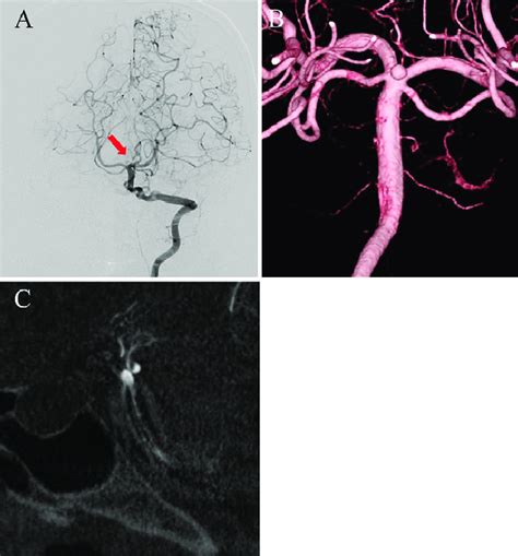 Second DSA On Day 17 A Left Vertebral Angiography Shows A