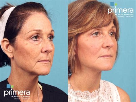 Microneedling Before After Photo Gallery Orlando 9984 Hot Sex Picture