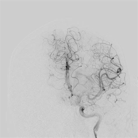 Ruptured Anterior Communicating Artery Aneurysm Image