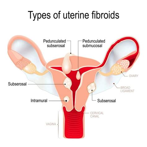 Fibroids - St. Louis, MO & Swansea, IL: Midwest Institute for Non ...