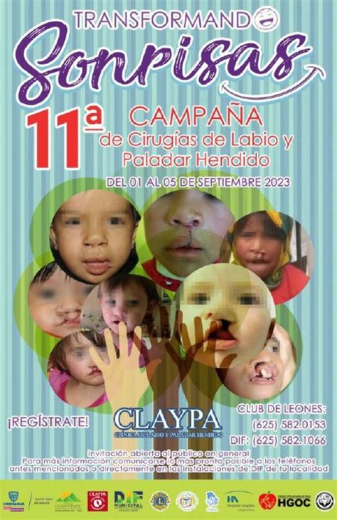 Invitan A Registrarse A Campa A De Cirug As Gratuitas De Labio Y