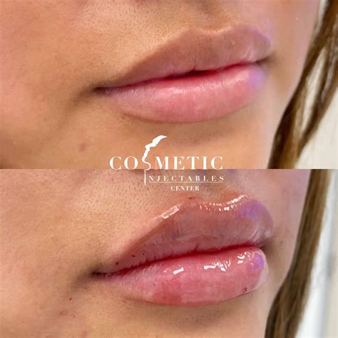 Lip Filler Cost Benefits Side Effects Reviews Sherman Oaks