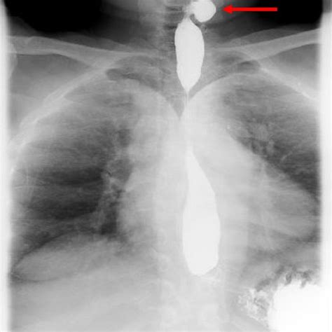 Barium Esophagram Showing A Contrast Filled Lateral Esophageal