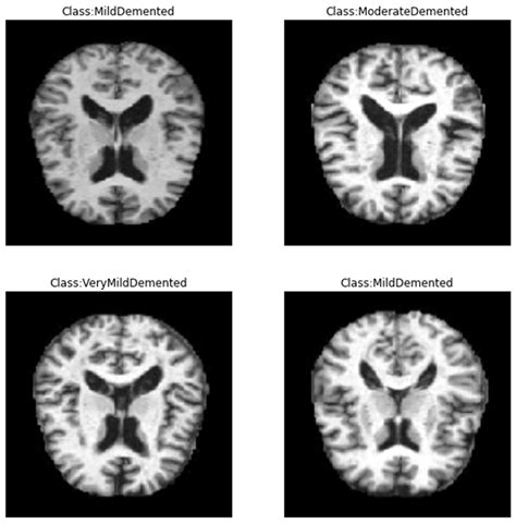 Accurate Detection Of Alzheimers Disease Using Lightweight Deep