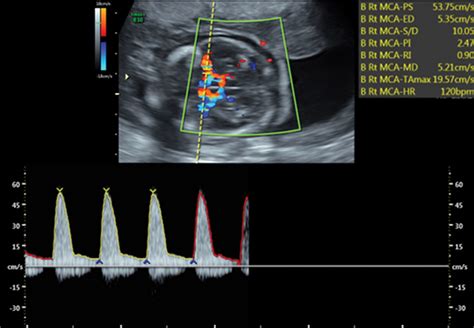 Doppler Us In The Evaluation Of Fetal Growth And Perinatal Health