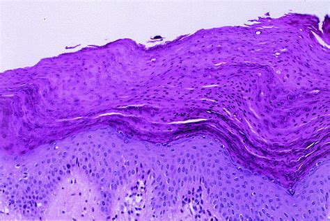 Parakeratosis Journal Of The American Academy Of Dermatology