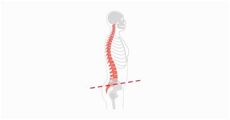 Posture Correction Strategies For Posterior Pelvic Tilt Dr Body Gadget