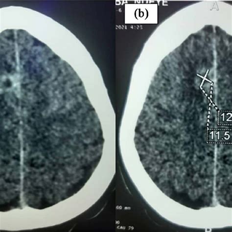 Cerebral Computed Tomography Images Without Injection Of Contrast Download Scientific Diagram