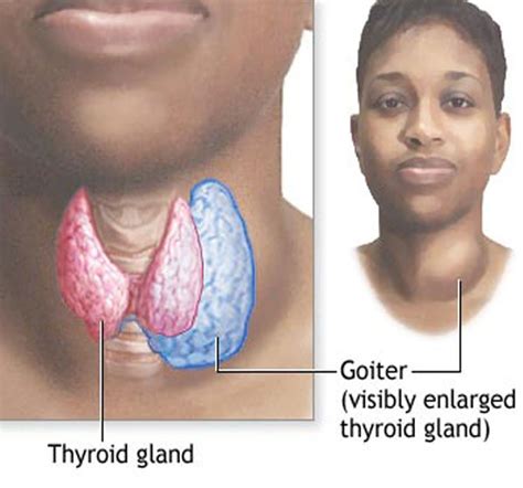 Goiter Iodine History 3 Thyroid Center Of Santa Monica