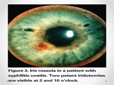 interstitial Keratitis