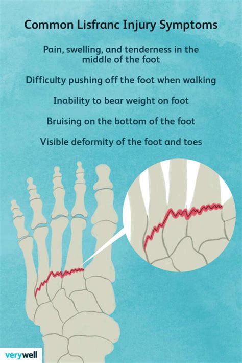 Lisfranc Fracture - Motus Physical Therapy