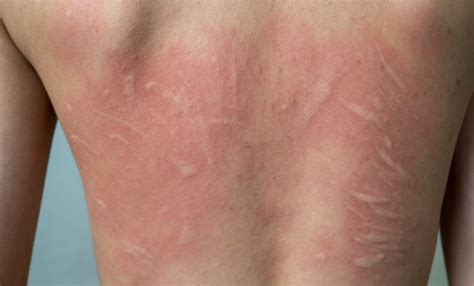 Consejos Para Combatir La Urticaria Cr Nica El Universal Hidalgo