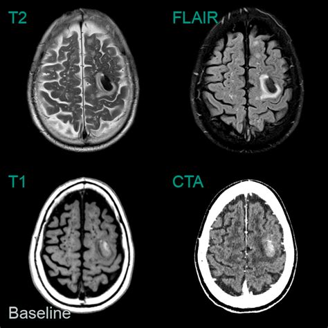 Cerebral Amyloid Angiopathy CAA NEURORADIOLOGY