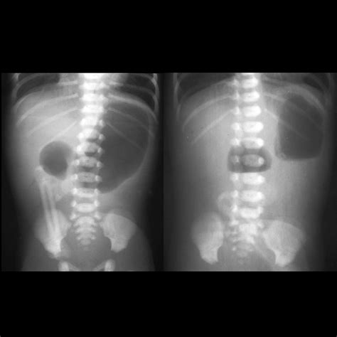 Duodenal Atresia Pediatric Radiology Reference Article Pediatric Imaging Pedsimaging