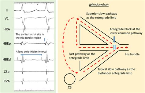 Superior Type Fast Slow Atrioventricular Nodal Reentrant Tachycardia