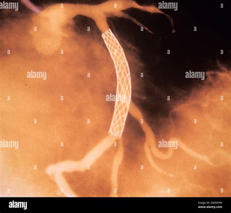 L Endoproth Se Coronaire Angiogramme De Couleur D Une Section