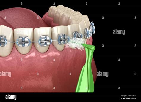 Limpieza interdental con cepillo dental y aparatos ortopédicos