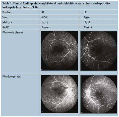 Cancer Associated Retinopathy Eye News