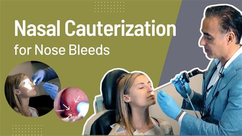 Nasal Cauterization For Nose Bleeds Epistaxis Nose Bleed Treatment