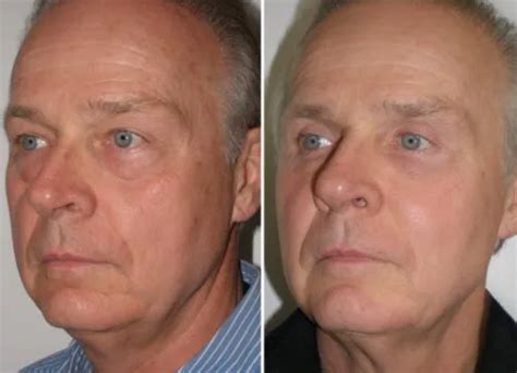 Facelifts For Men Richmond Va Men S Cosmetic Facial Surgery