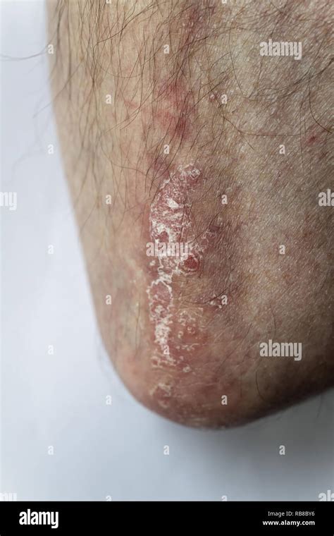 PSORIASIS Stock Photo Alamy