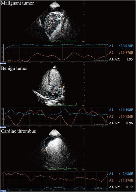 Frontiers The Diagnostic Accuracy Of Contrast Echocardiography In