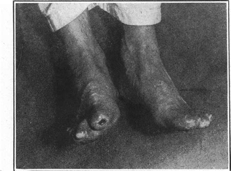 World War 1 Trench Foot