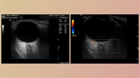 Case Report Acute Monocular Painless Vision Loss In Elderly Man Fcep