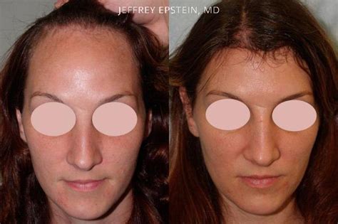 Forehead Reduction Surgery Photos Miami FL Patient37260