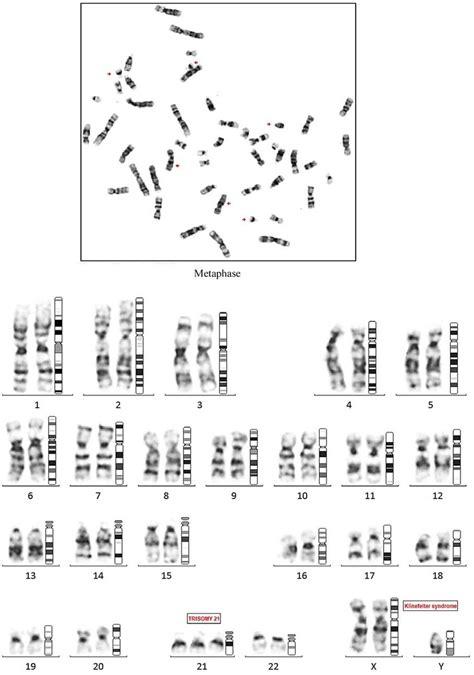 Karyotype showing 3 copies of chromosome 21, 2 copies of X and 1 copy ...