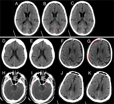 Brain Hemorrhage Scan