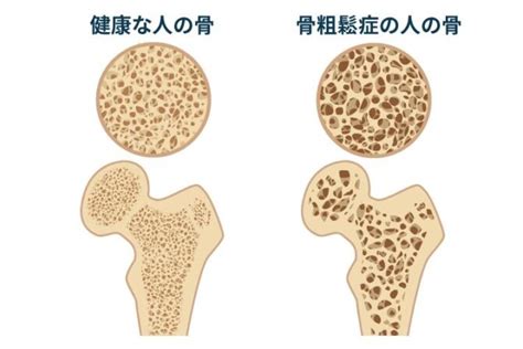 健康に長生きするために ～骨粗鬆症と予防～ 東広島整形外科クリニック