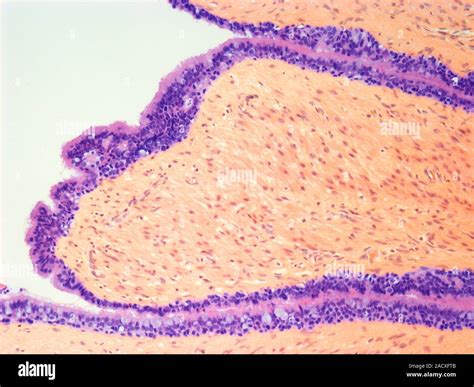 Testicular Cancer Light Micrograph Of A Section Of A Testicular