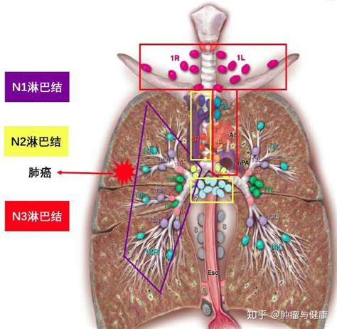 肺癌的真正的分期和治疗，看懂这些知识，再也不花一分冤枉钱 知乎